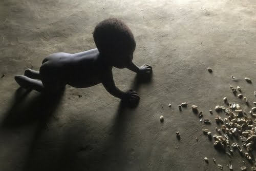 desnutrición infantil